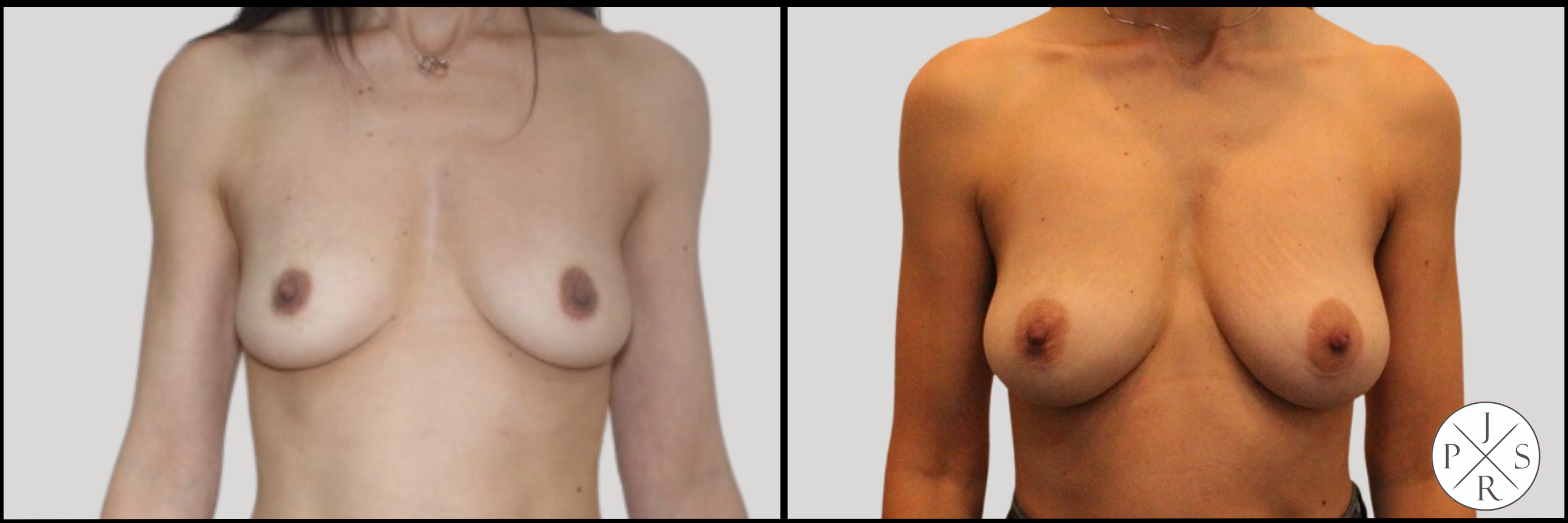 Fat Transfer Breast Augmentation Before & After Image